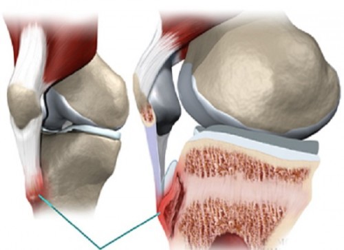 Cách chữa đau nhức xương khớp gối an toàn hiệu quả