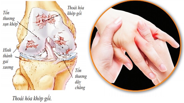 Cách chữa đau nhức xương khớp