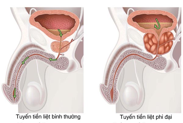 Cách chữa phì đại tuyến tiền liệt an toàn hiệu quả 