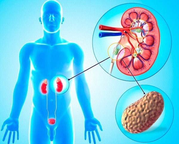 Cách chữa sỏi thận bằng nước dừa an toàn hiệu quả