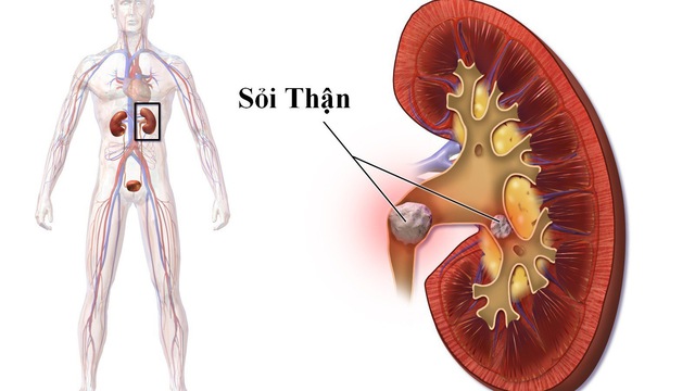 Cách chữa sỏi thận bằng quả sung an toàn hiệu quả