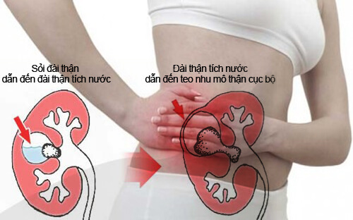 cách chữa sỏi thận hiệu quả nhất bằng thực phẩm chức năng