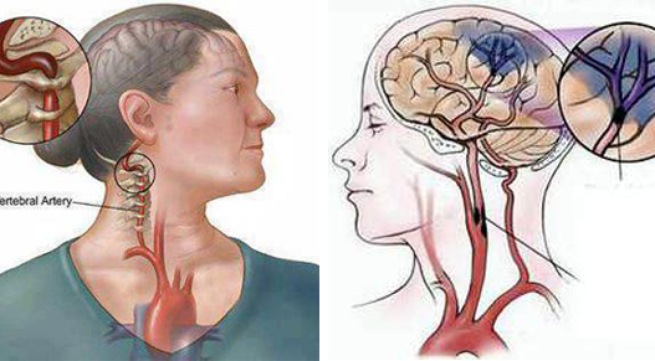 Cách chữa tai biến mạch máu não như thế nào