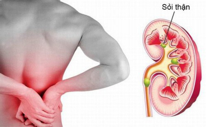 Cách chữa trị sỏi thận an toàn tại nhà