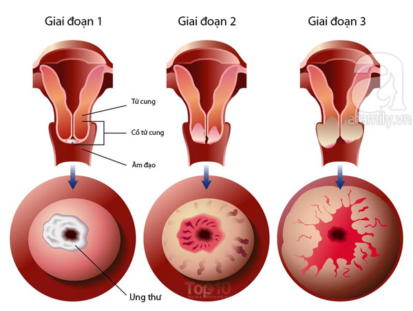 Cách chữa ung thư cổ tử cung giai đoạn đầu an toàn hiệu quả