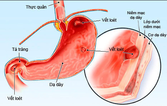 Cách chữa viêm loét dạ dày như thế nào