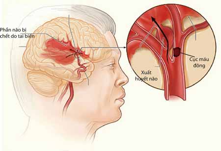 Cách điều trị bệnh tai biến mạch máu não an toàn hiệu quả