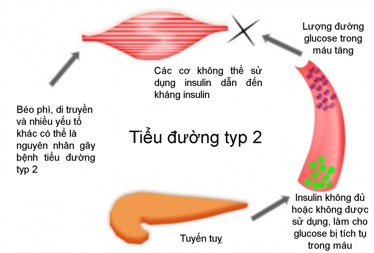 Cách điều trị bệnh tiểu đường type 2 toàn diện