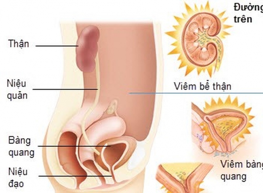 Cách điều trị nhiễm khuẩn đường tiết niệu như thế nào