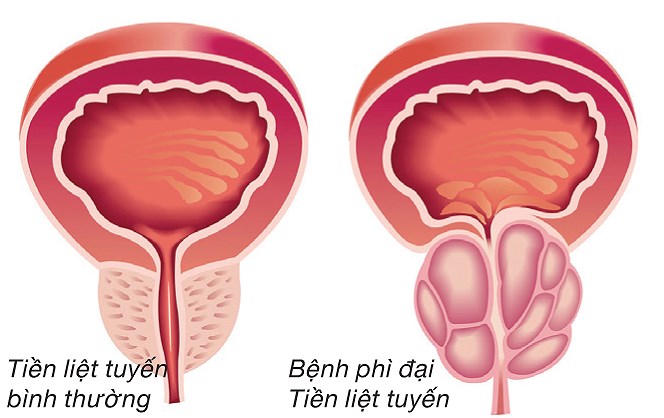 Cách điều trị phì đại tuyến tiền liệt lành tính