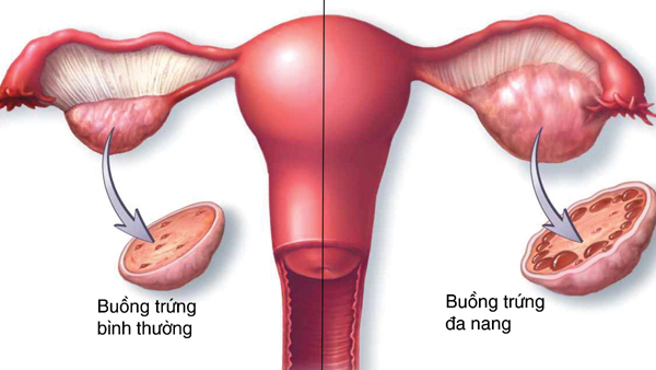 Cách điều trị rối loạn kinh nguyệt như thế nào