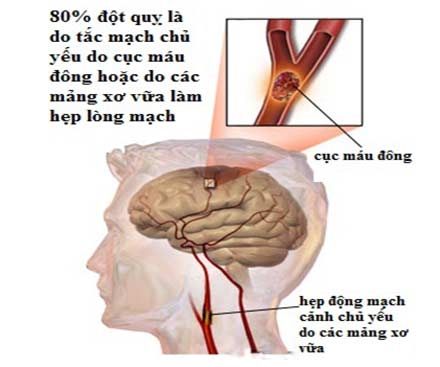 Cách điều trị tai biến mạch máu não an toàn hiệu quả