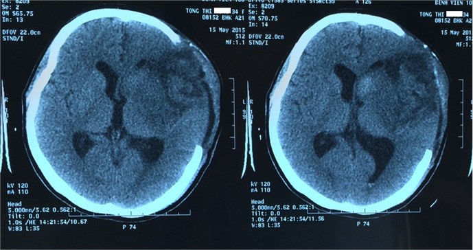 Cách điều trị tai biến mạch máu não như thế nào