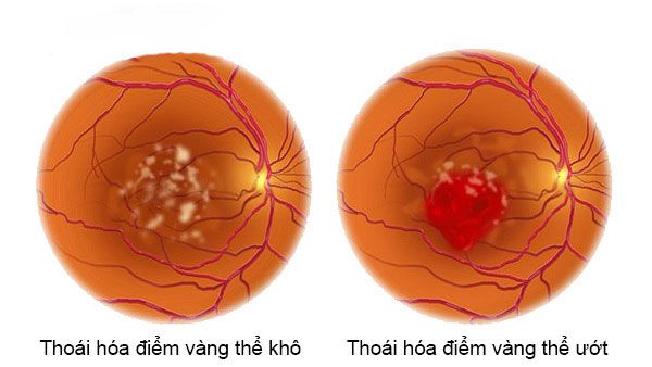 Cách điều trị thoái hóa điểm vàng an toàn hiệu quả 