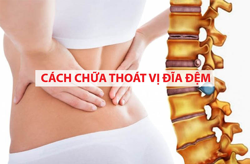 Cách điều trị thoát vị đĩa đệm an toàn hiệu quả