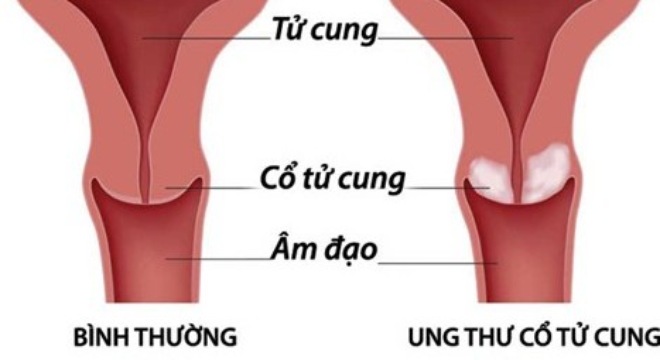 Cách điều trị ung thư cổ tử cung giai đoạn 2 như thế nào