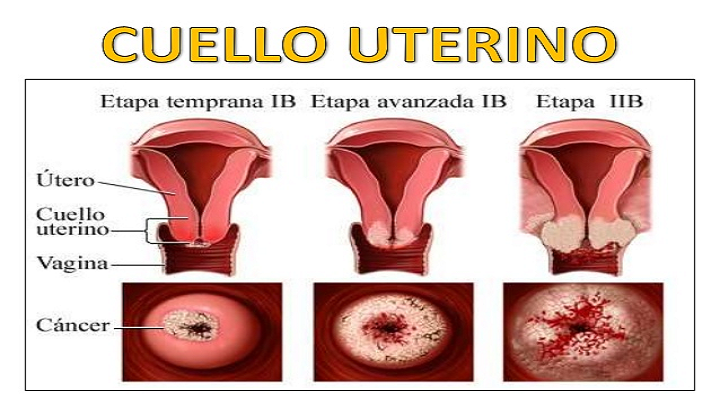 Cách điều trị ung thư cổ tử cung giai đoạn 2 như thế nào