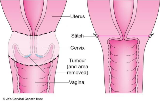 Cách điều trị ung thư cổ tử cung giai đoạn 2 như thế nào