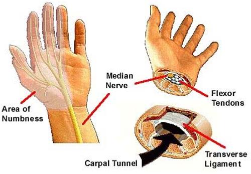 Cách điều trị viêm bao gân cổ tay như thế nào