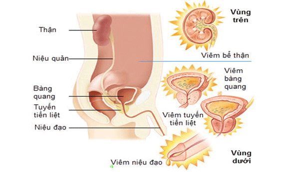 Cách điều trị viêm đường tiết niệu tại nhà an toàn hiệu quả