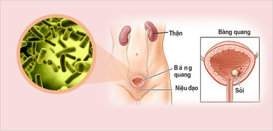 Cách điều trị viêm đường tiết niệu tại nhà an toàn hiệu quả