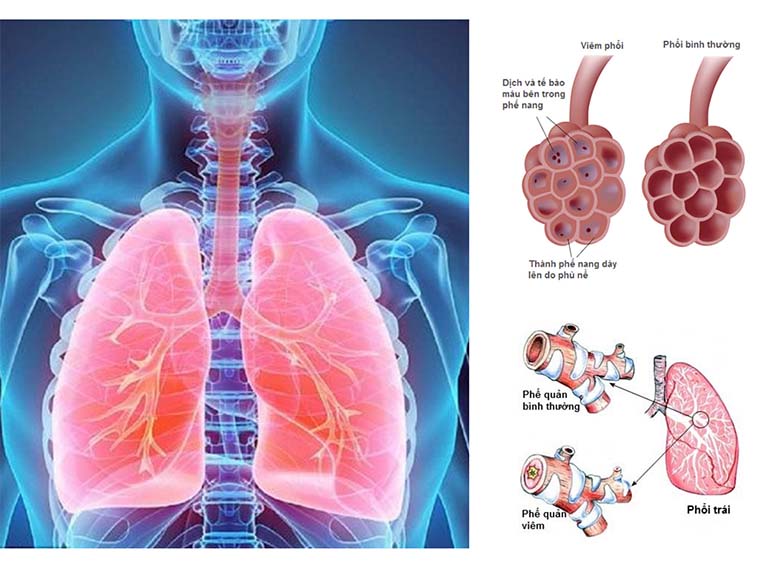 Cách điều trị viêm phế quản ở người lớn như thế nào