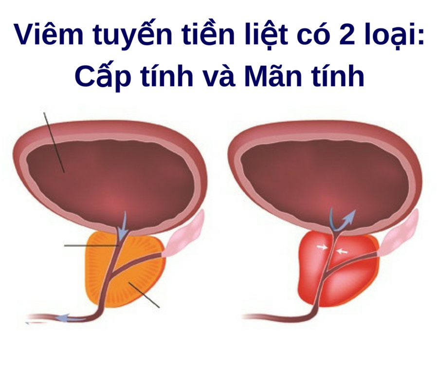 Cách điều trị viêm tuyến tiền liệt ở nam giới hiệu quả