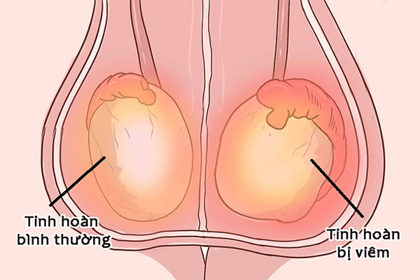 Cách điều trị yếu sinh lý ở nam giới