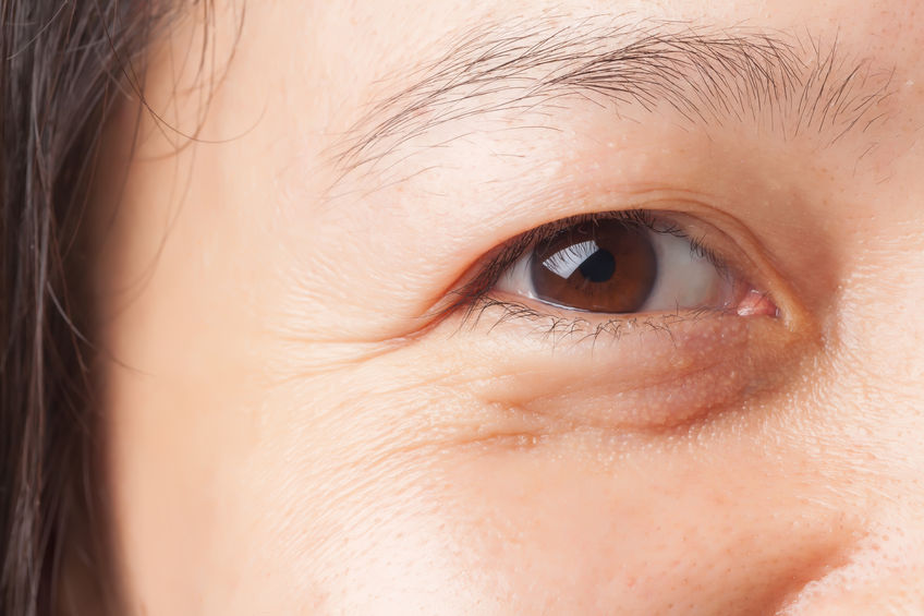 Cách giảm nếp nhăn quanh mắt an toàn hiệu quả
