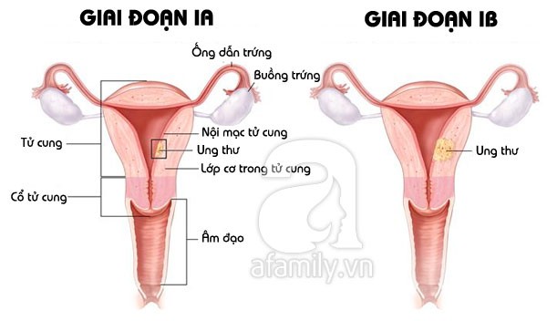 cách phát hiện ung thư buồng trứng