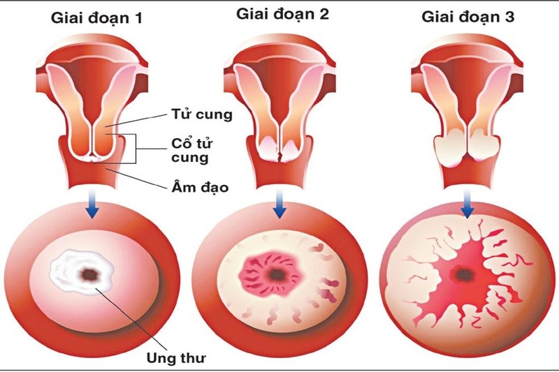 Cách phòng bệnh ung thư cổ tử cung như thế nào