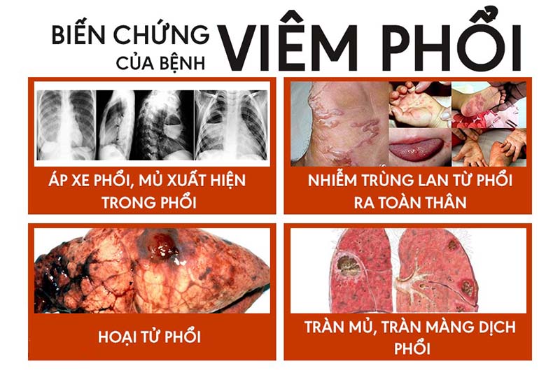 Cách phòng ngừa biến chứng viêm phổi 