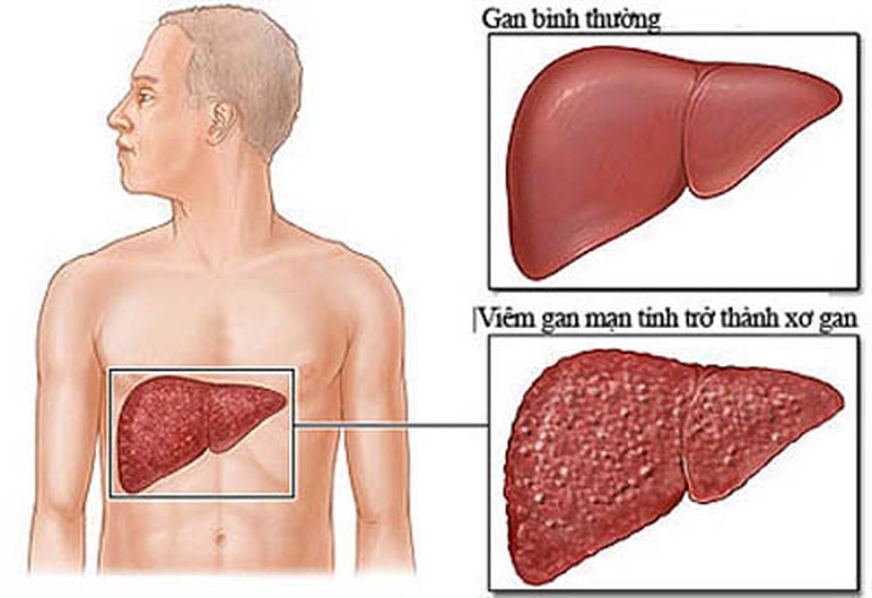 Cách sống chung với bệnh viêm gan b mãn tính như thế nào