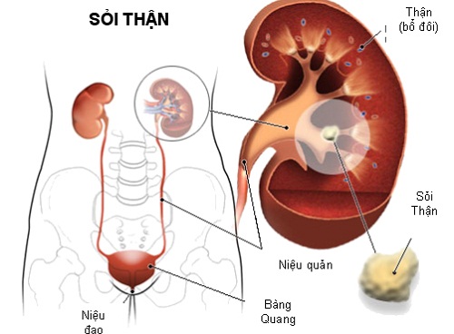 Cách trị bệnh sỏi thận hiệu quả nhất hiện nay