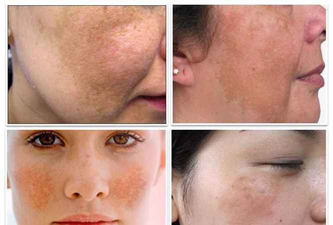 Cách trị nám da bằng dầu dừa an toàn hiệu quả