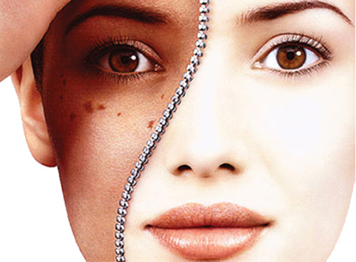 Cách trị nám da và tàn nhang an toàn hiệu quả tại nhà