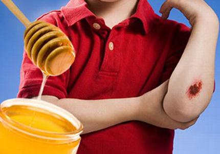 Cách trị nám tàn nhang bằng mật ong an toàn hiệu quả