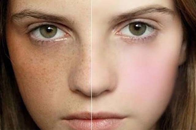 Cách trị tàn nhang trên mặt an toàn hiệu quả