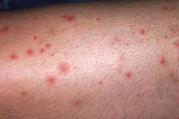 Cây sài đất có tác dụng gì và cách dùng sao cho hiệu quả