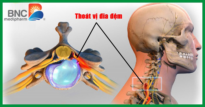 Chẩn đoán thoát vị đĩa đệm đốt sống cổ