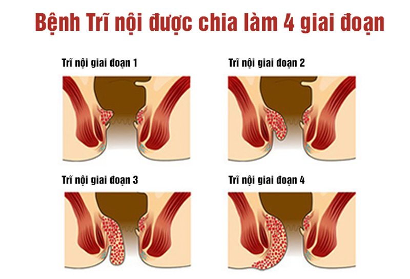 Chẩn đoán và điều trị bệnh trĩ nội