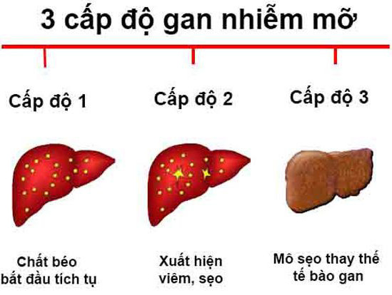 Chế độ ăn cho người gan nhiễm mỡ độ 2 như thế nào2