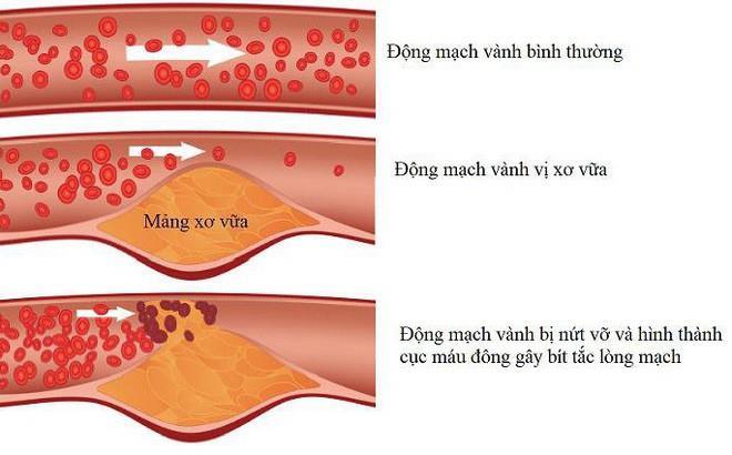 Chi phí đặt stent mạch vành là bao nhiêu