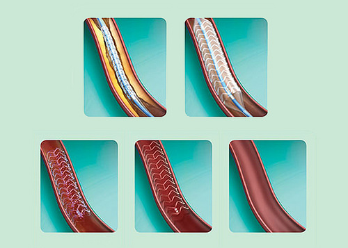 Chi phí đặt stent mạch vành là bao nhiêu
