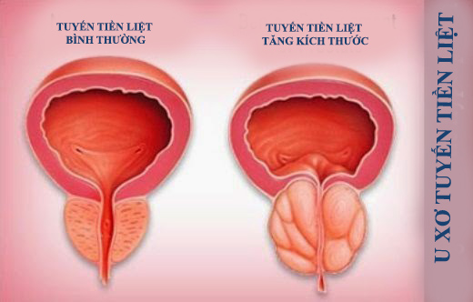 Chỉ số trung bình của tiền liệt tuyến là bao nhiêu