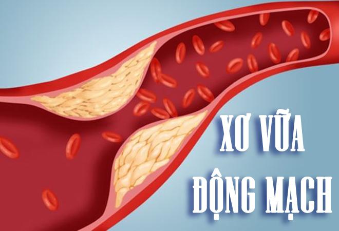 cholesterol cao là bệnh gì và cách phòng bệnh ra sao