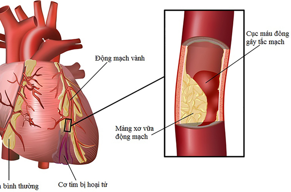 Chữa bệnh hẹp mạch vành như thế nào