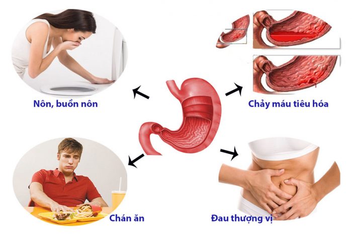 Chữa đau dạ dày không dùng thuốc 
