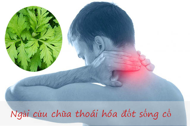 Chữa thoái hóa đốt sống cổ bằng ngải cứu