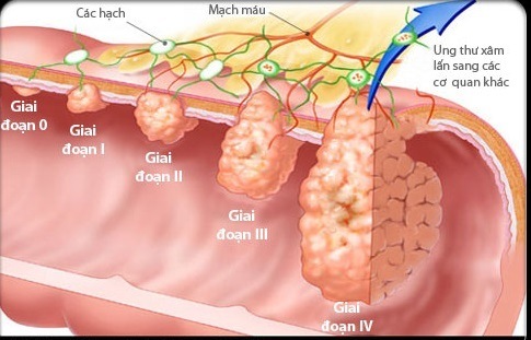 Chữa ung thư dạ dày giai đoạn cuối như thế nào 